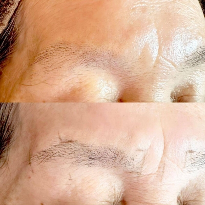 発毛サポート • 地肌ケアも同時に